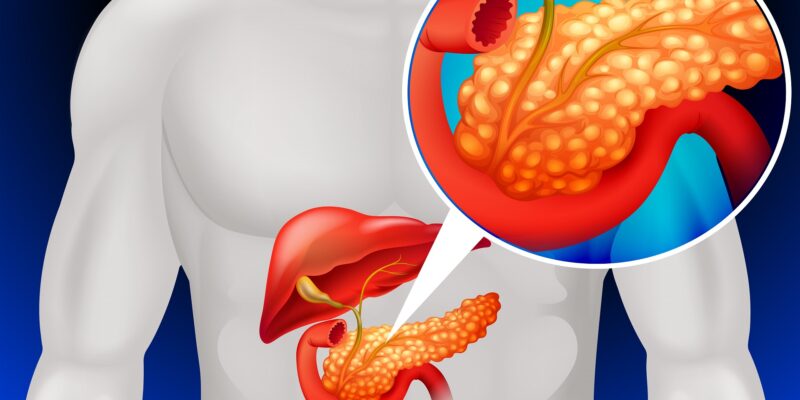 Pancreatite Crônica: causas, sintomas e tratamento