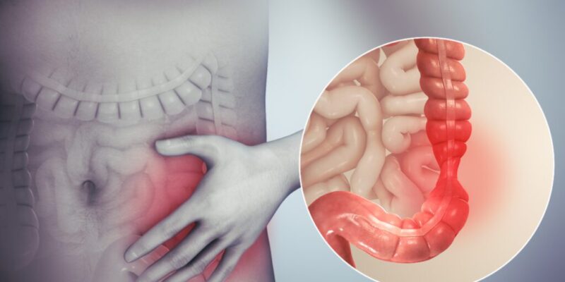 Síndrome do Intestino Irritável (SII): sintomas, causas e tratamento