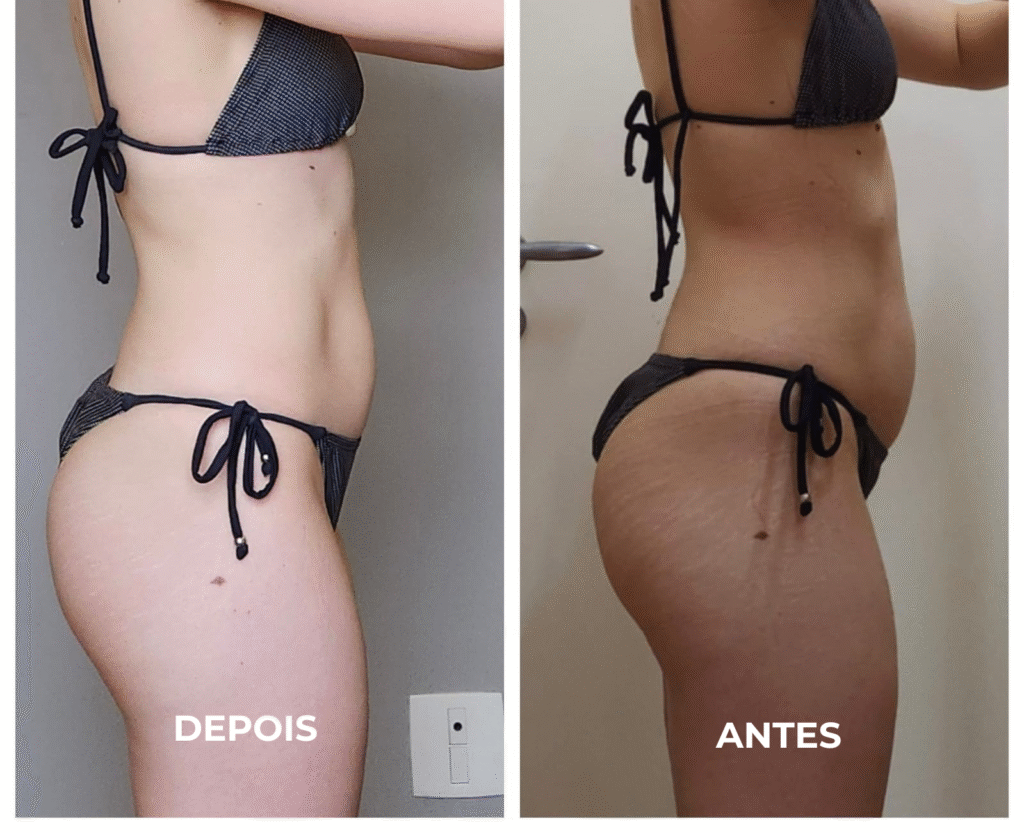 Antes e depois de paciente com distensão abdominal funcional.
