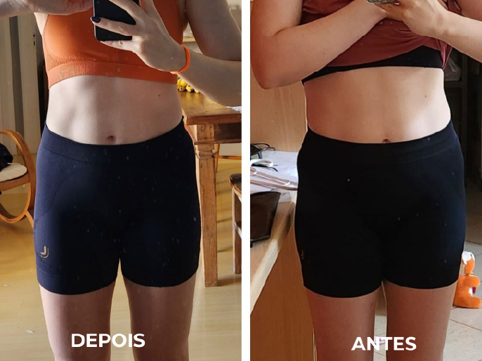 Antes e depois de paciente com distensão abdominal funcional.